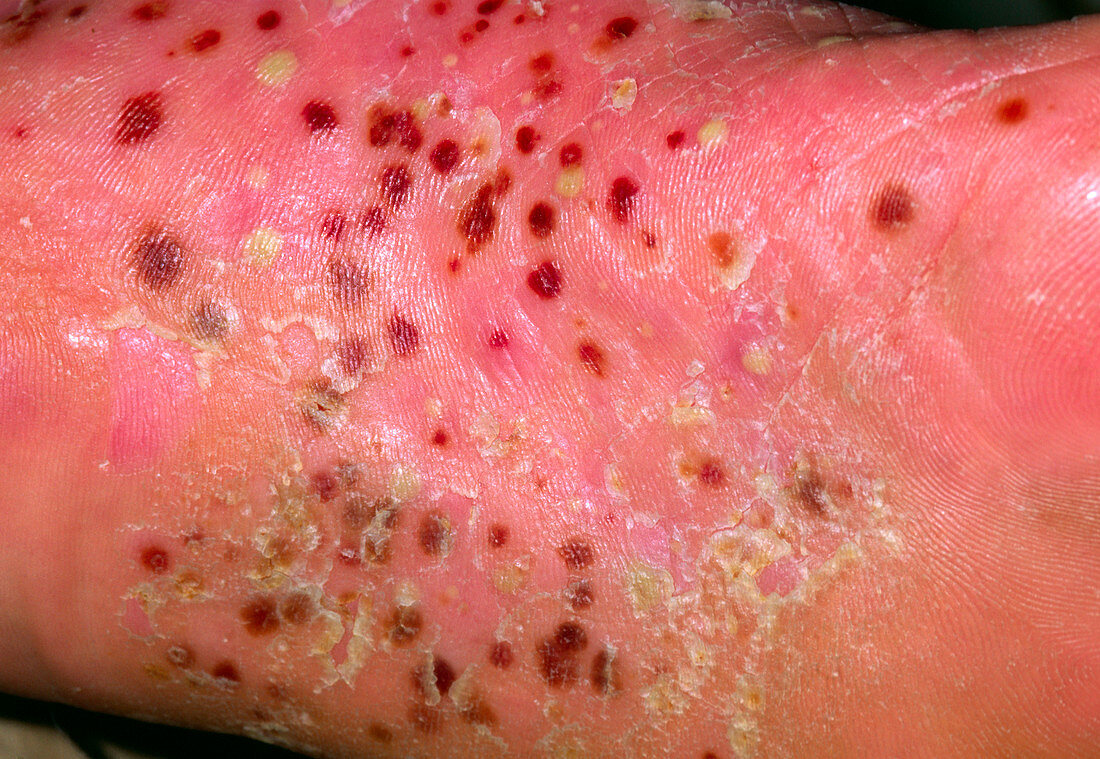Close-up of pustular psoriasis on foot