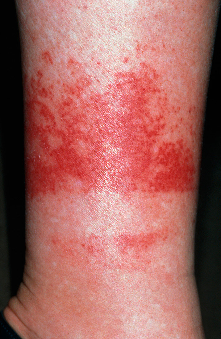 Purpura rash on woman's leg above sock line
