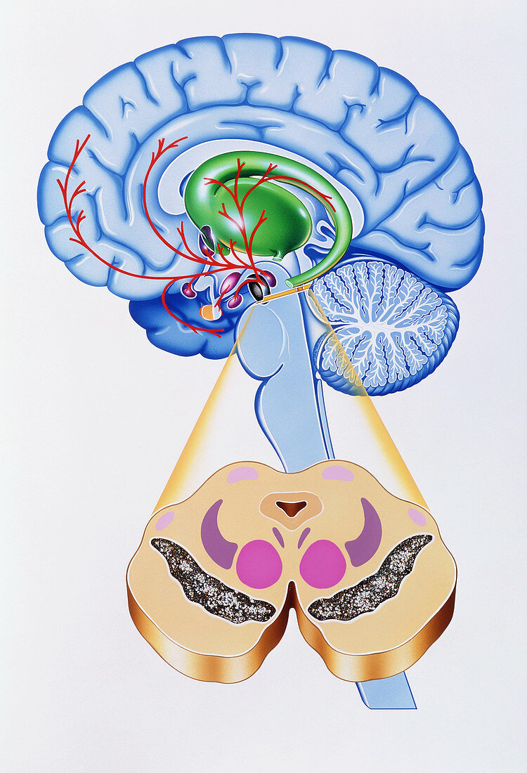 Artwork of brain areas in Parkinson's disease