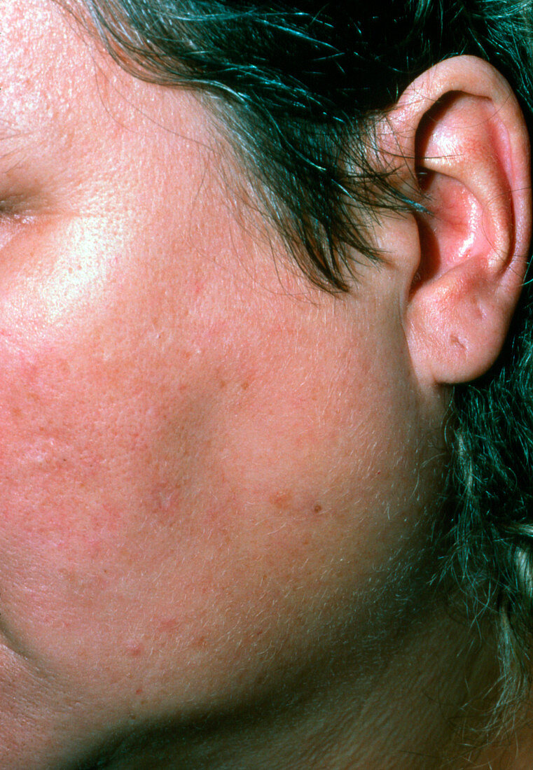 Parotid swelling due to blocked salivary duct