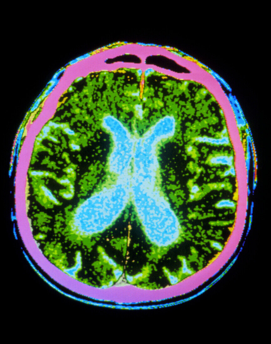 Coloured CT scan of a brain in Parkinson's disease
