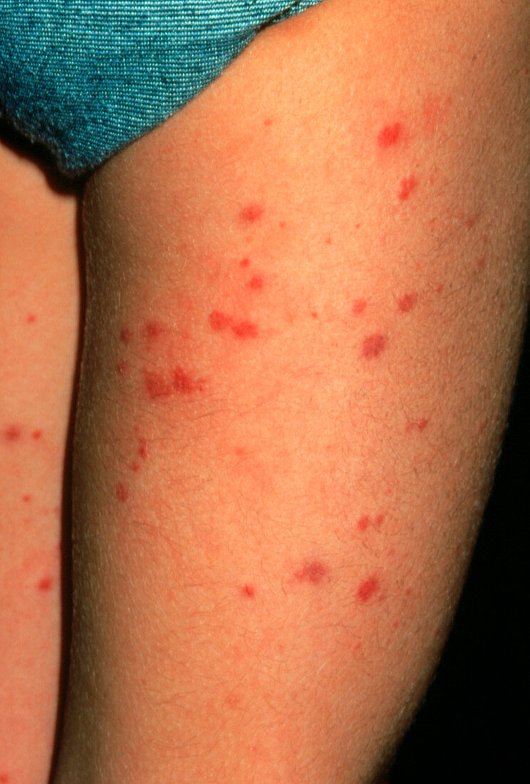 Henoch Schonlein purpura rash on boy's legs