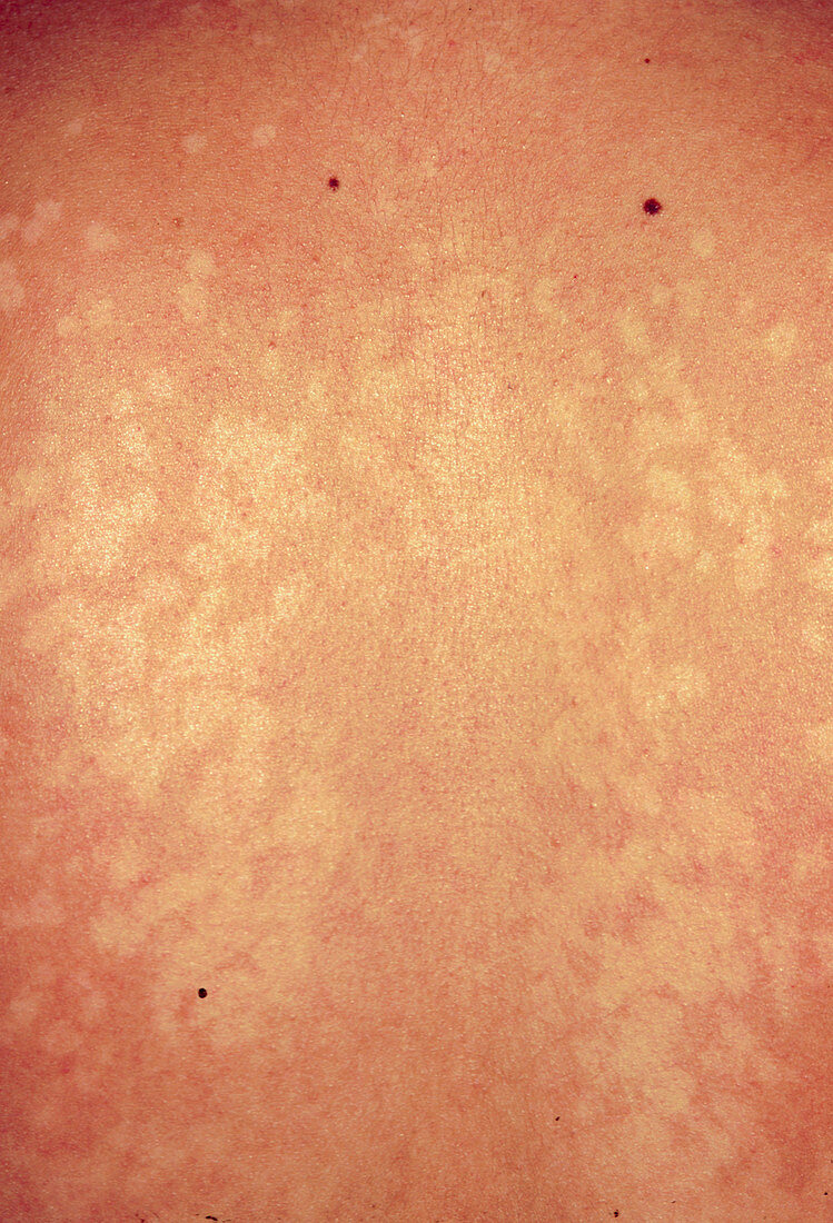 Pityriasis versicolor causing light skin patches