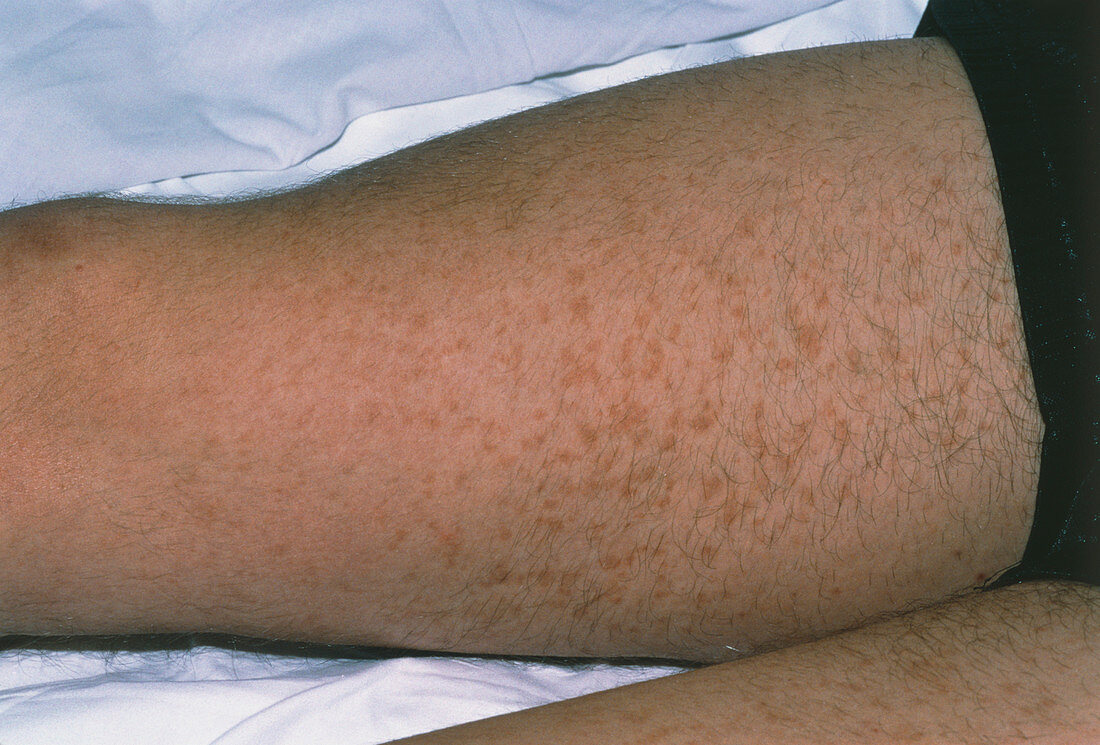 Henoch Schonlein purpura rash on a man's legs