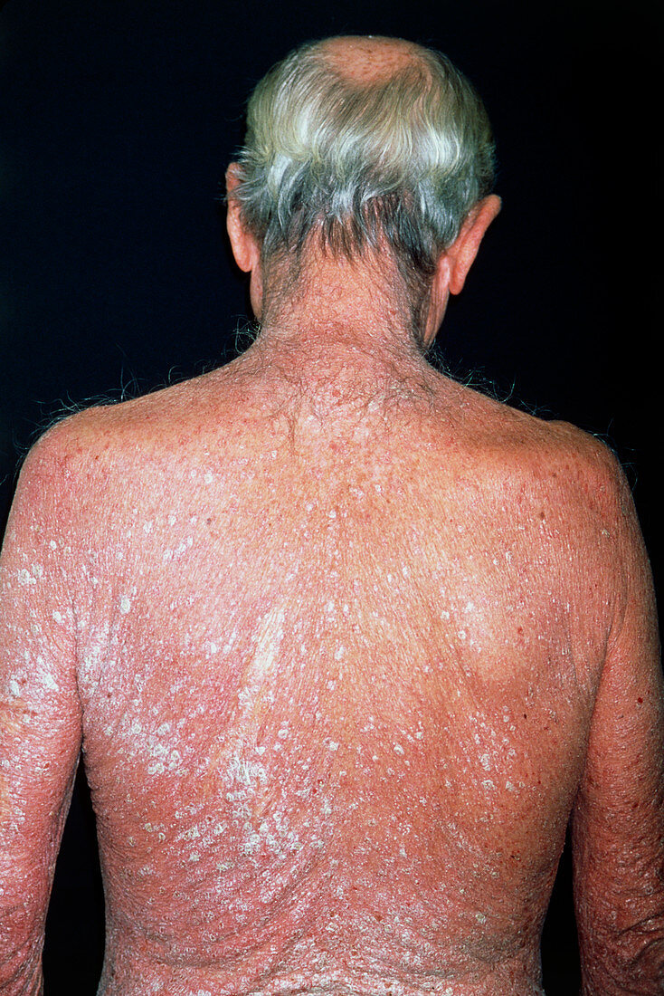 Psoriasis on the back of a 63 year old man
