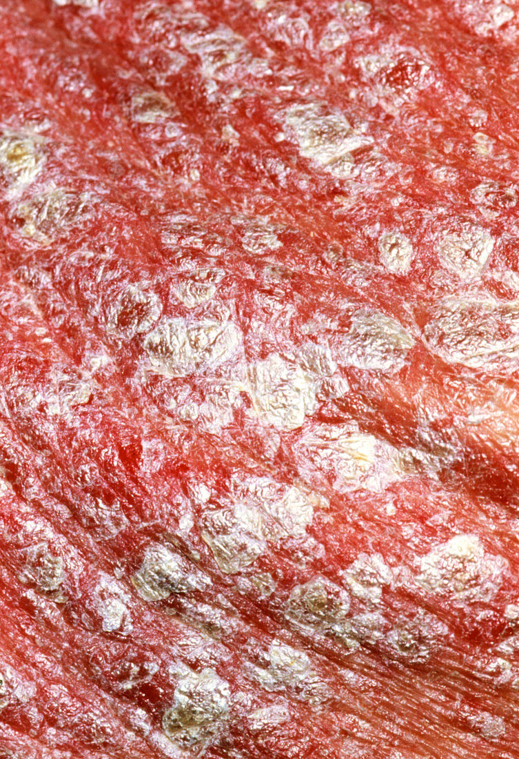 Close-up of 63 year old man's skin with psoriasis