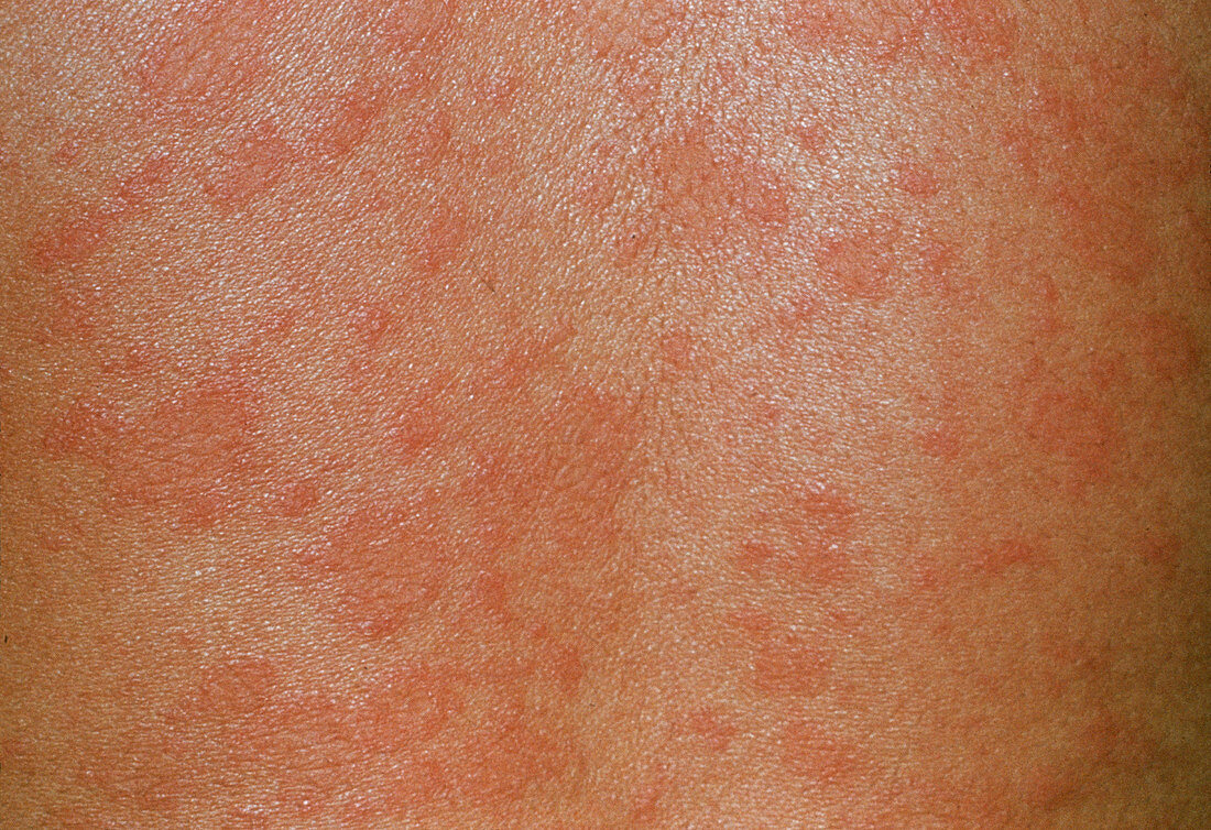 Pityriasis rosea skin rash