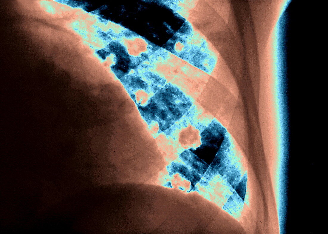 Porocephaliasis lung infection,X-ray