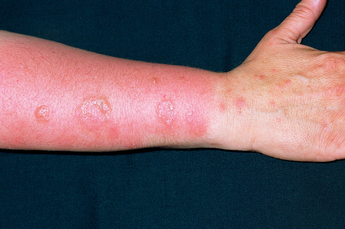 Psoriasis