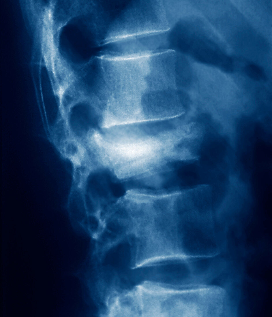 Osteoporosis,X-ray