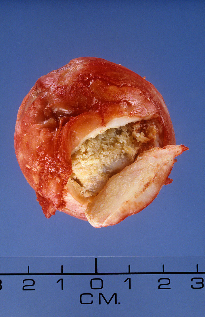 Avascular necrosis of the femur