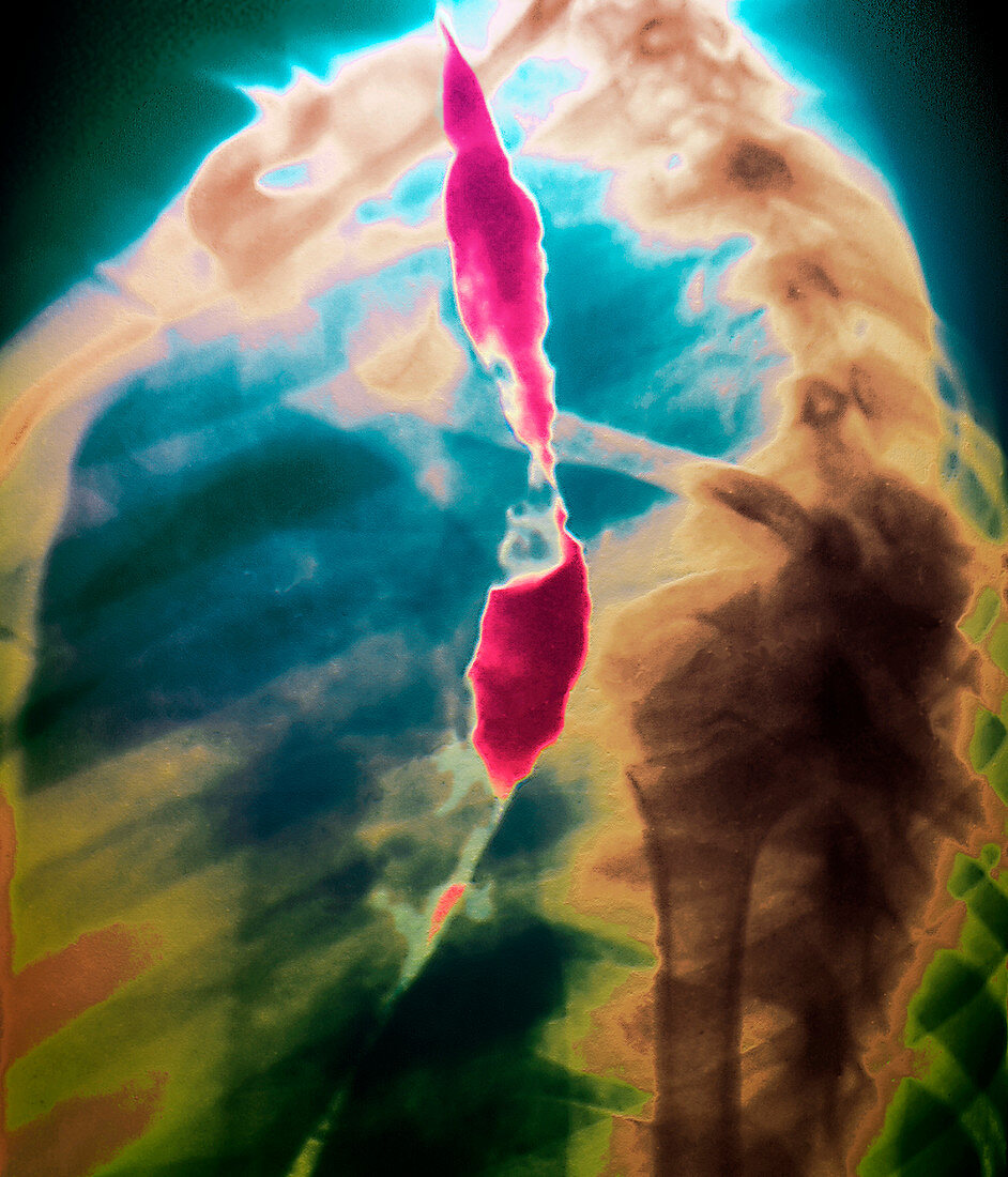 Oesophageal stricture,X-ray