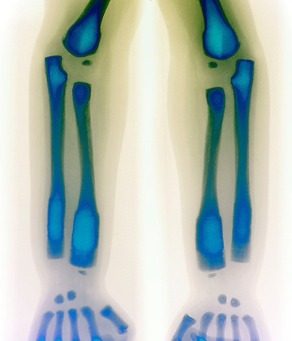 Osteopetrosis,X-ray