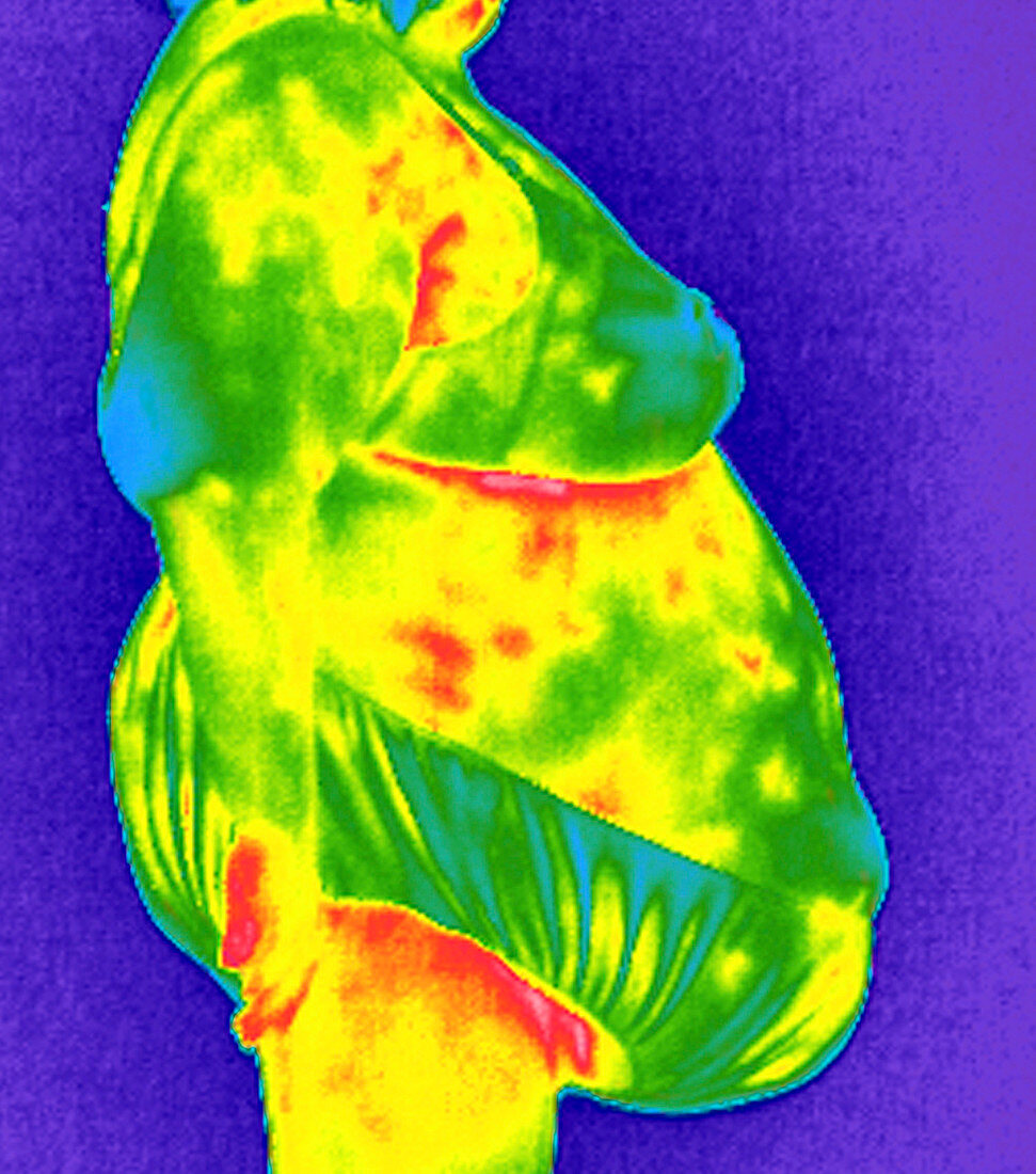 Obese woman,thermogram