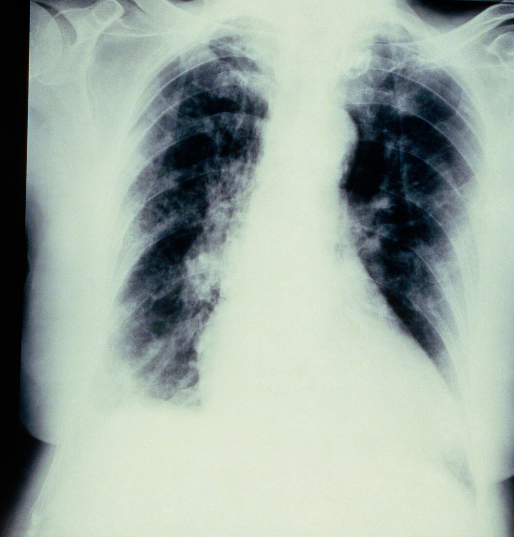 Chest X-ray showing bronchopneumonia