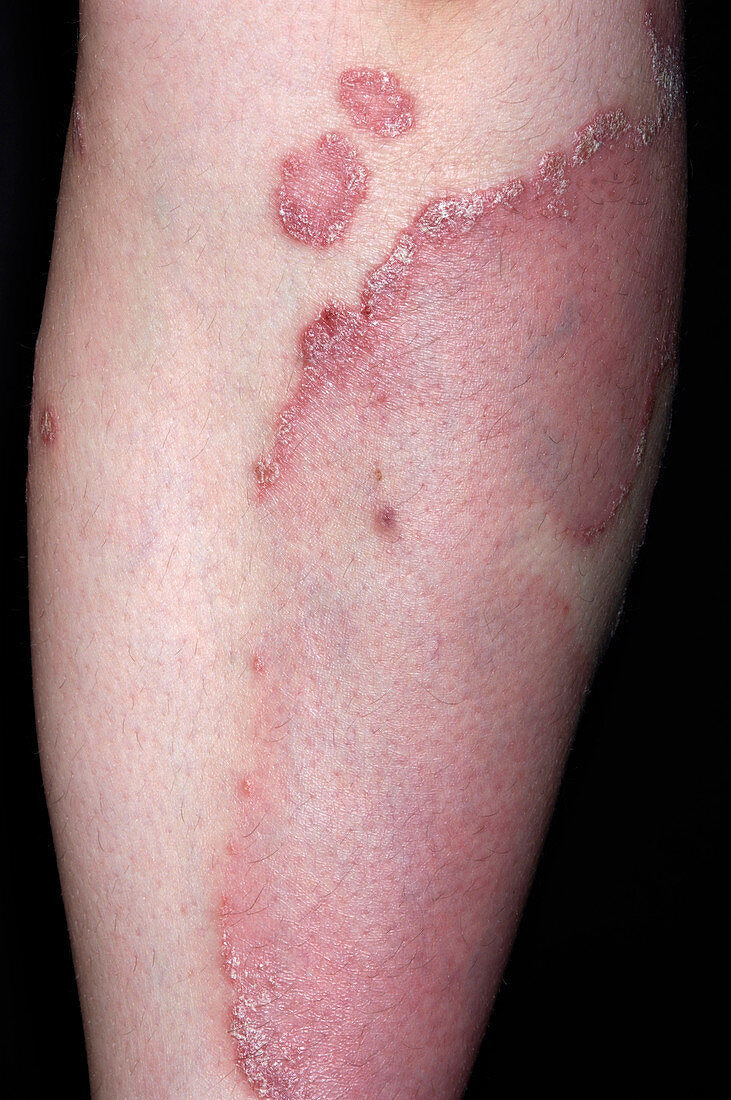 Psoriasis after 8 weeks of treatment