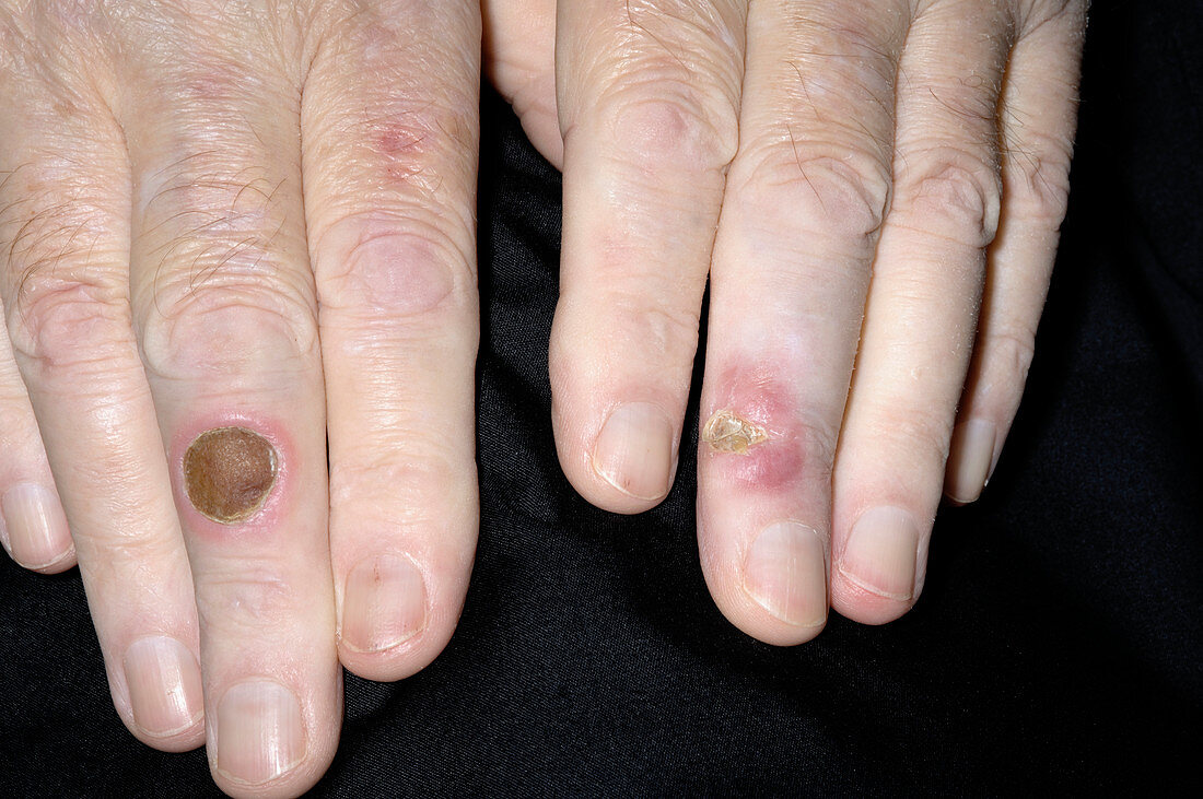 Pyoderma ulcers
