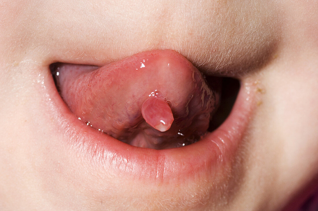 Tongue polyp