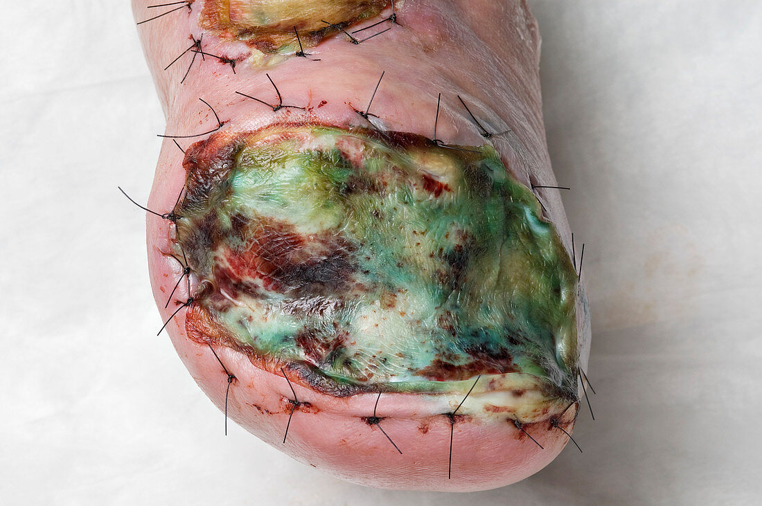 Infected skin graft