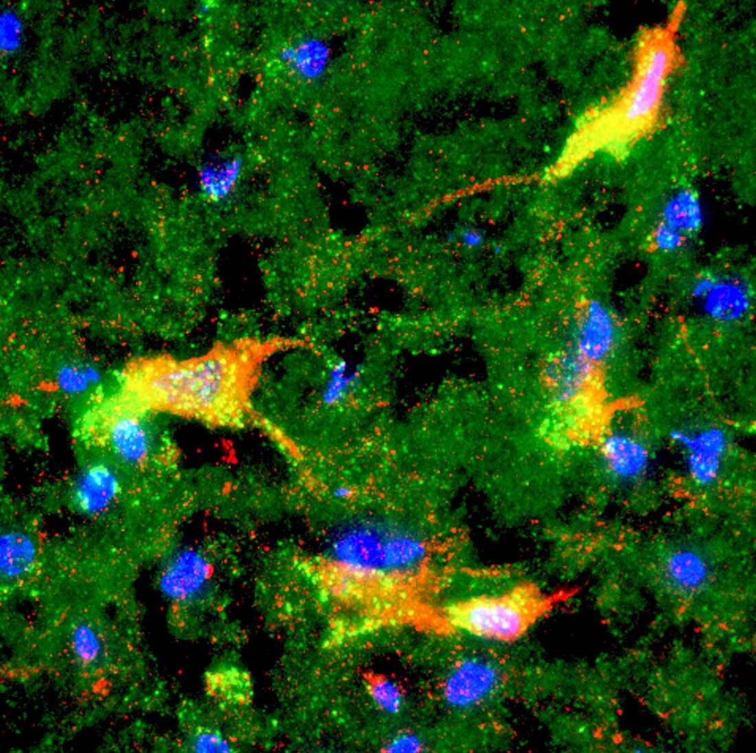 Brain protein in Parkinson's research