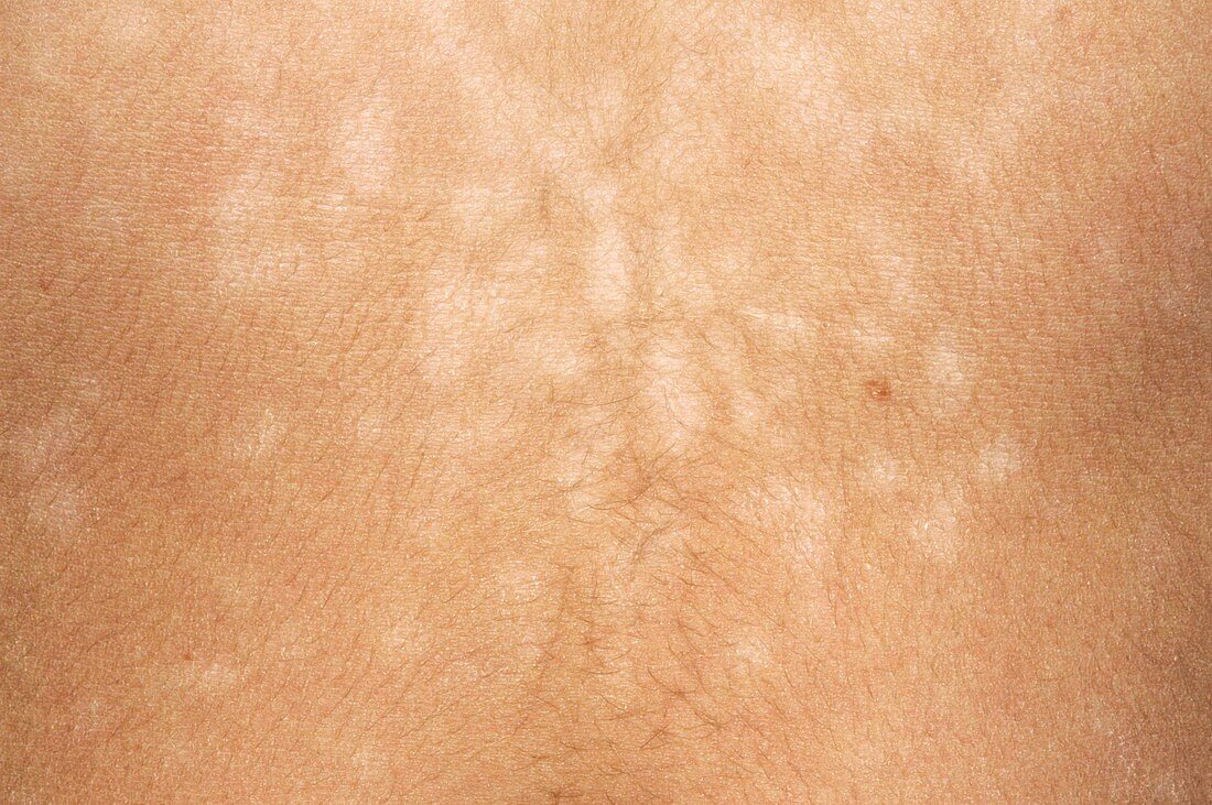 Pityriasis versicolor skin infection