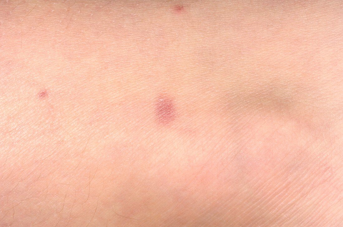 Henoch-Schonlein purpura spots
