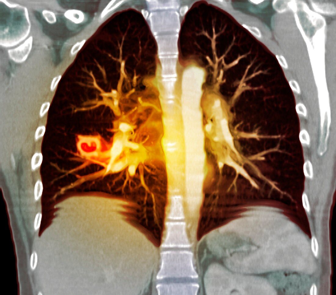 Lung lesions,CT scan