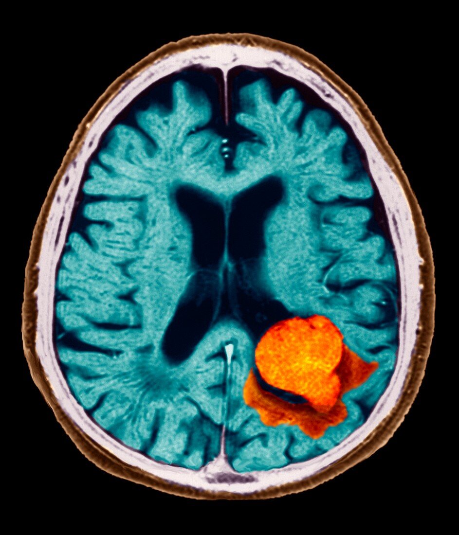 Brain lesion,MRI scan