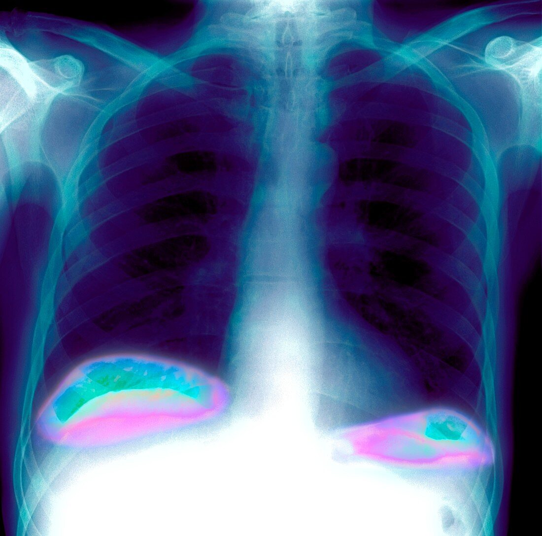 Abdominal air pocket,X-ray