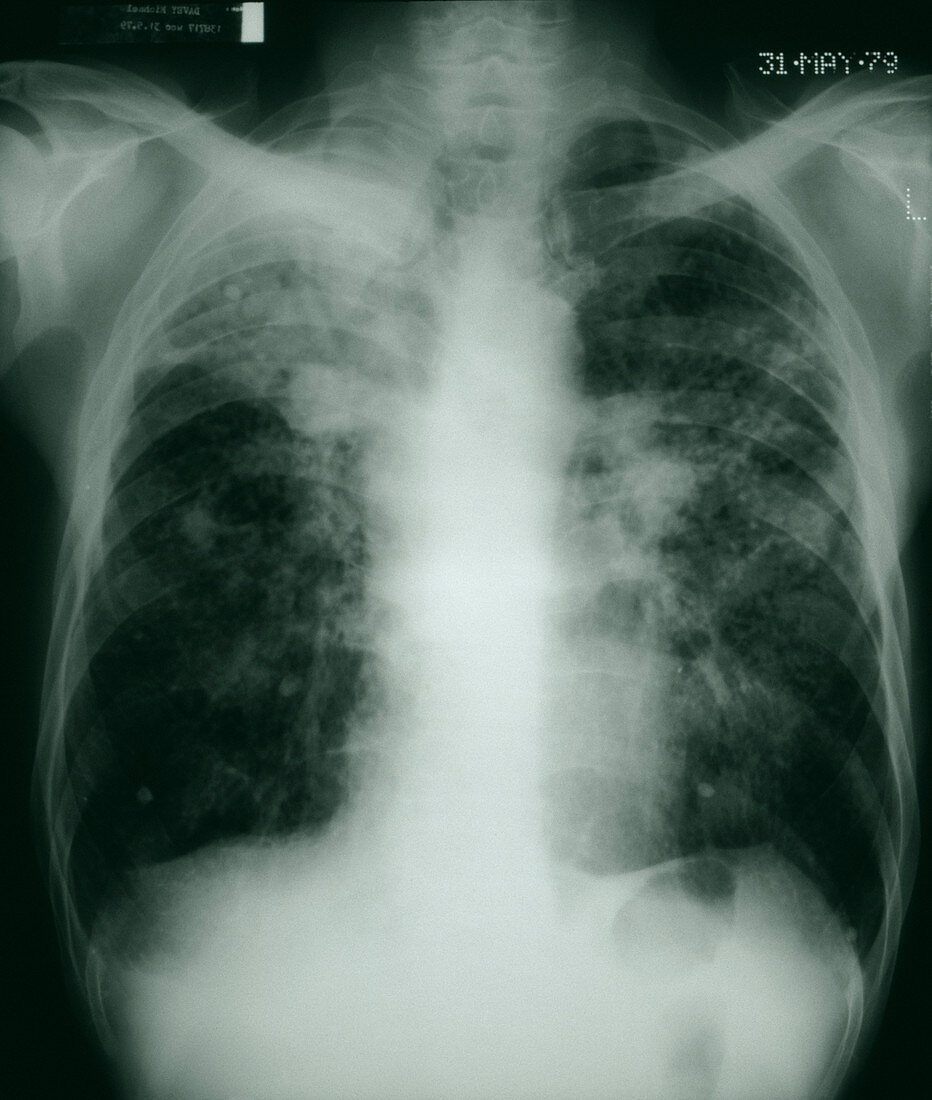 Pneumoconiosis,X-ray