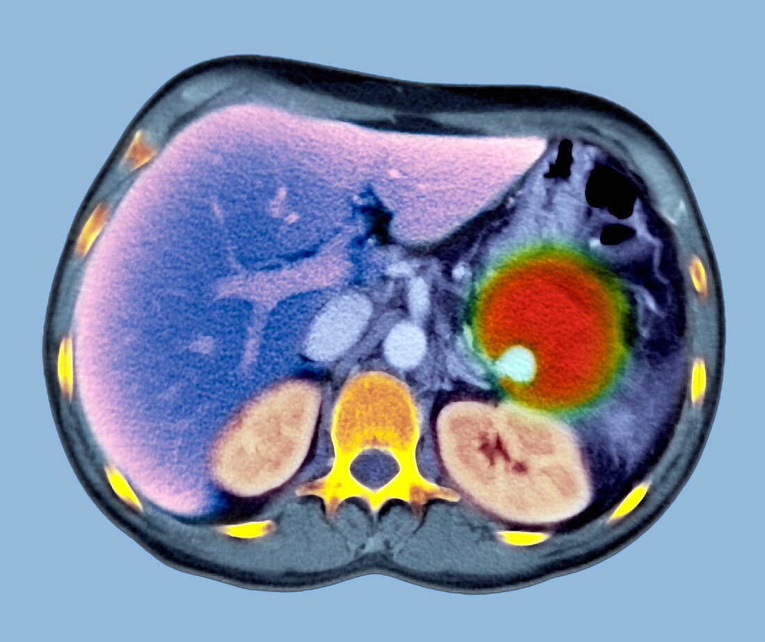 Pancreatitis,CT scan