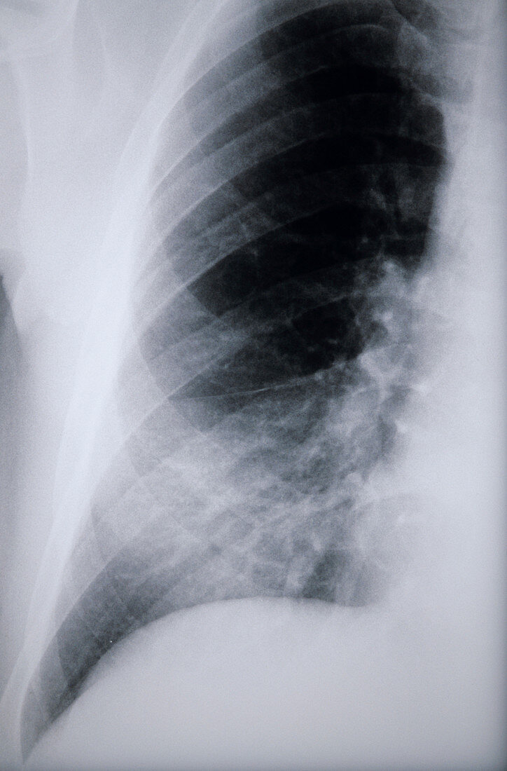 Pneumonia,lung X-ray