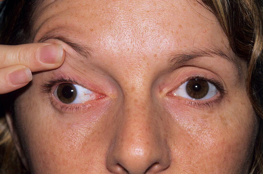 Oculomotor palsy in a woman's face