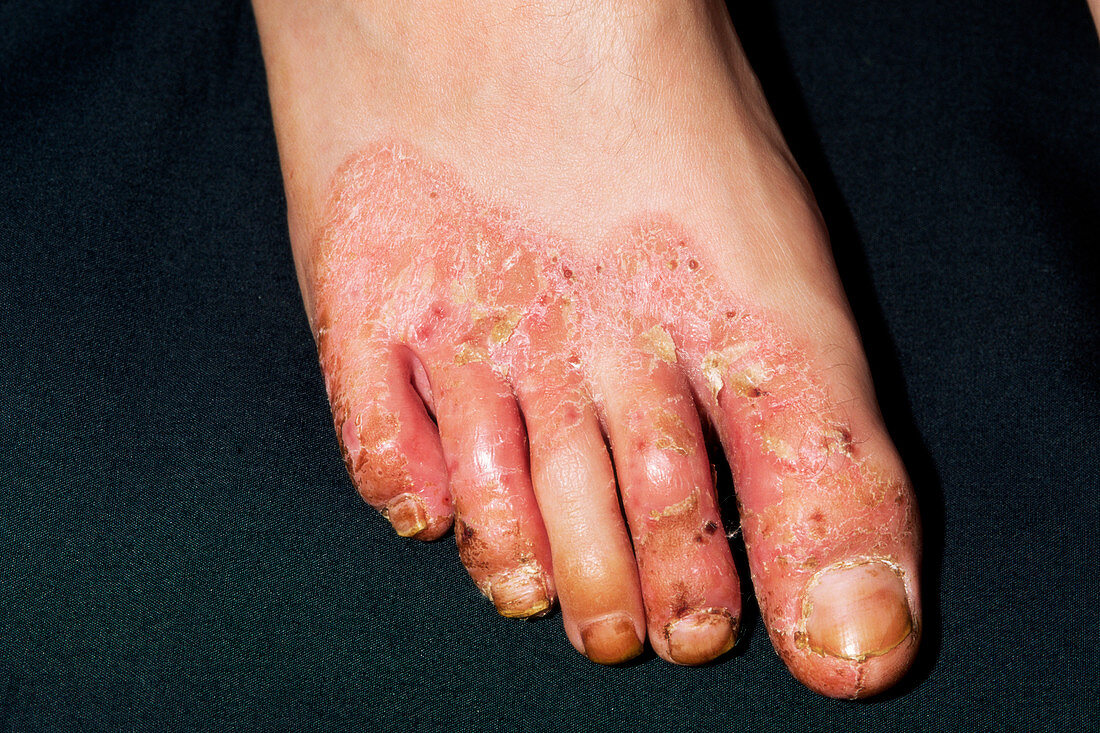 Psoriasis before treatment