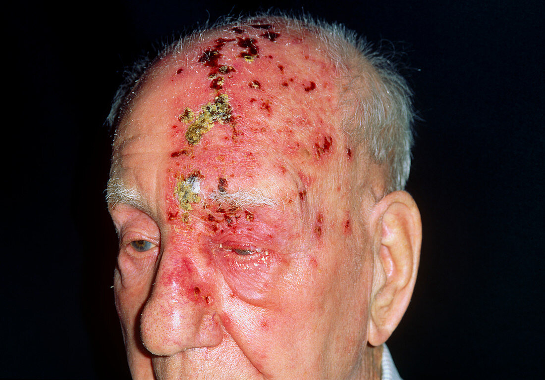 Shingles attack on head of elderly male,5th day