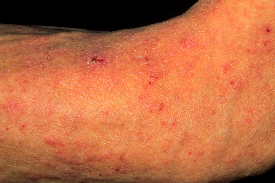 Scabies skin infection seen on man's arm