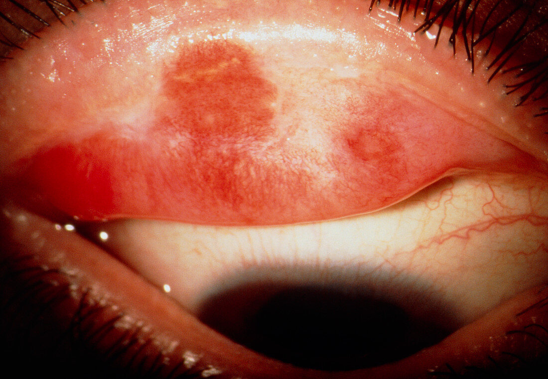 Red eyelid of patient: Stevens-Johnson syndrome