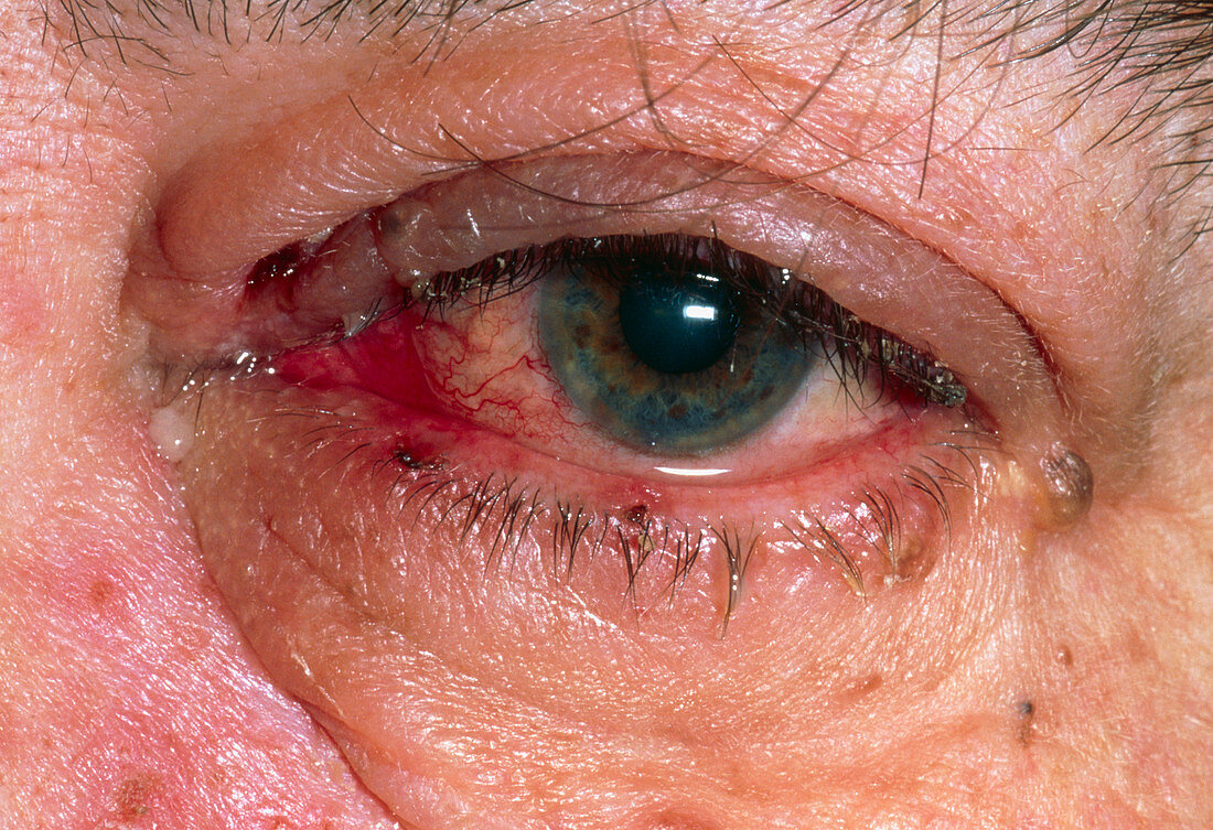 Eye affected by herpes zoster (shingles)