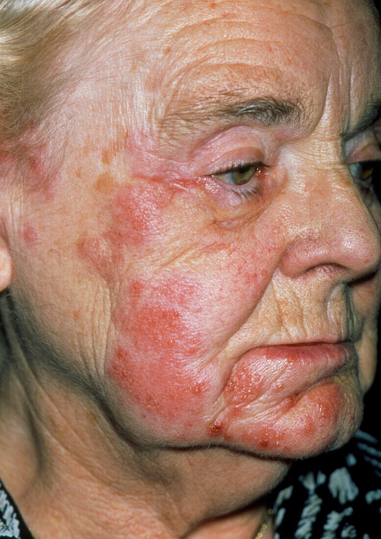 Herpes zoster rash on an elderly woman's face