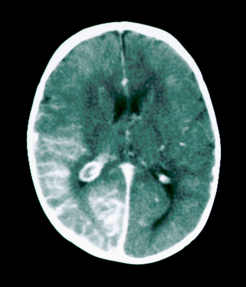 MRI brain scan showing Sturge-Weber syndrome