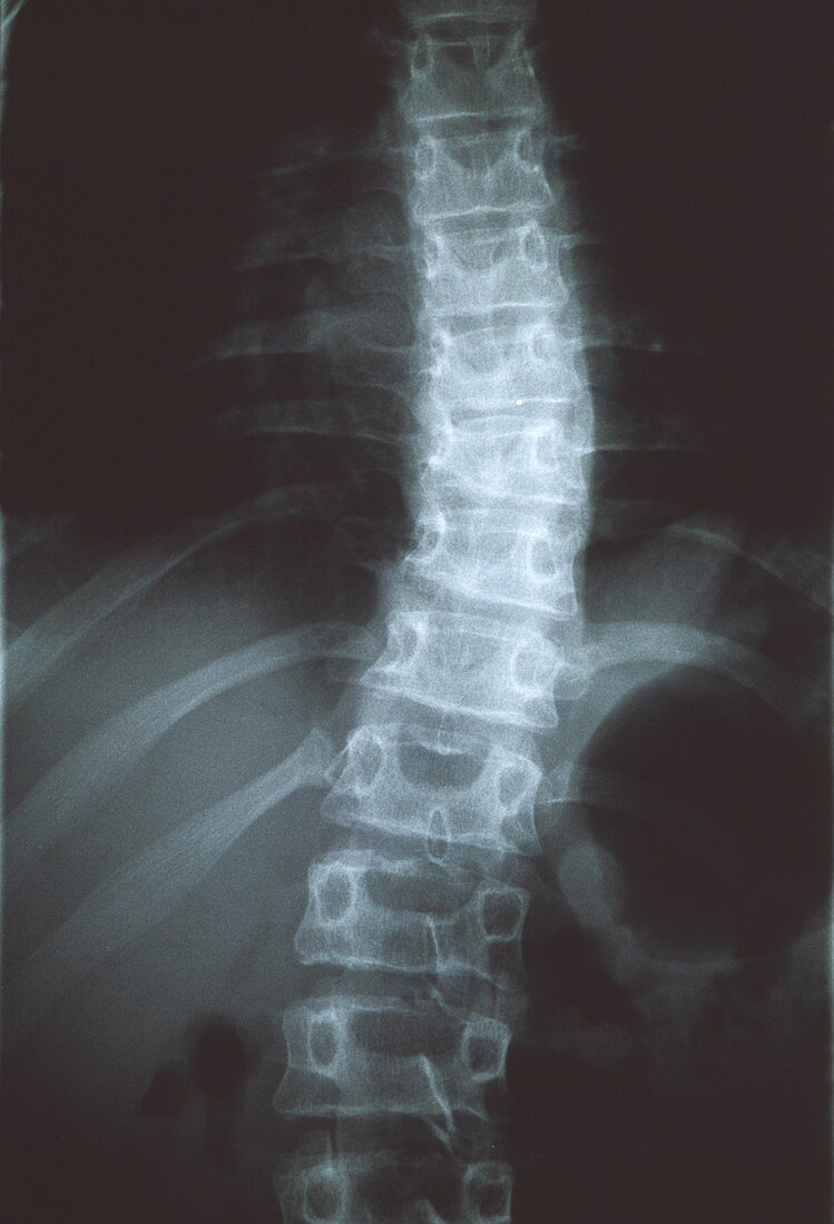 Soto's syndrome,X-ray