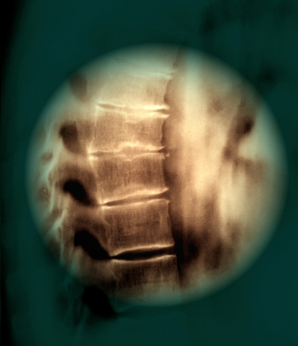 Scheuermann's disease,CT scan