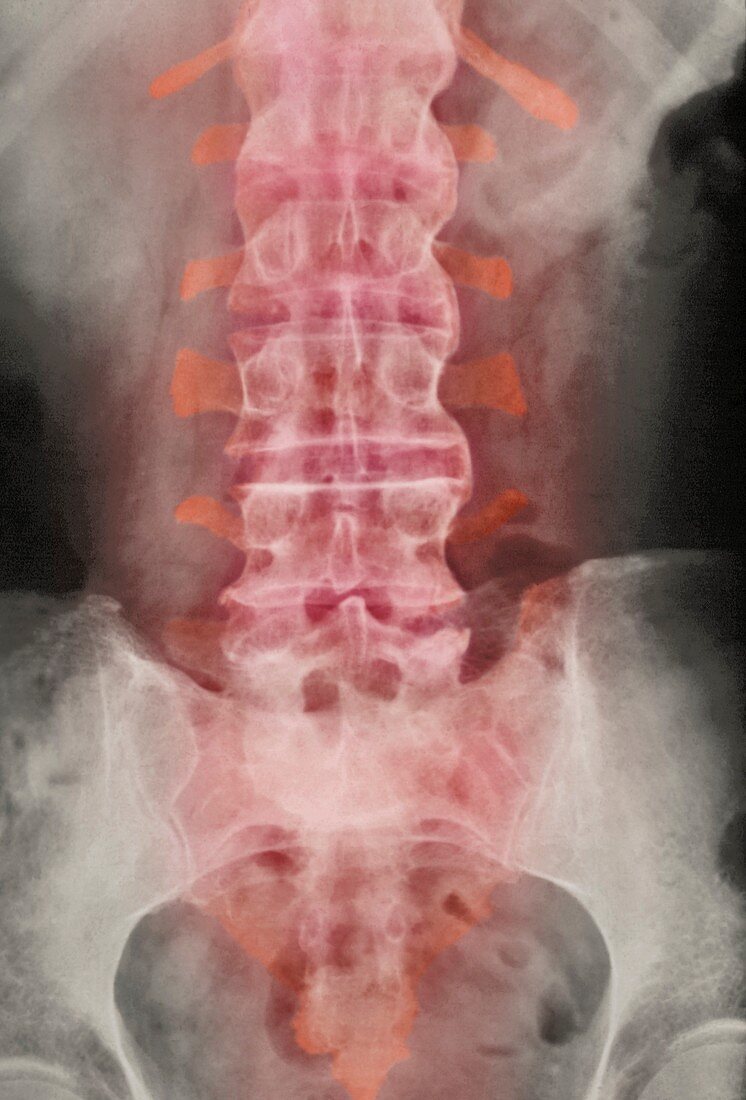 Spondylitis,X-ray