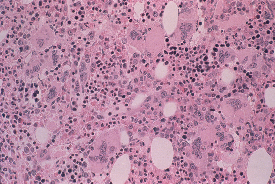 Enlarged spleen,light micrograph