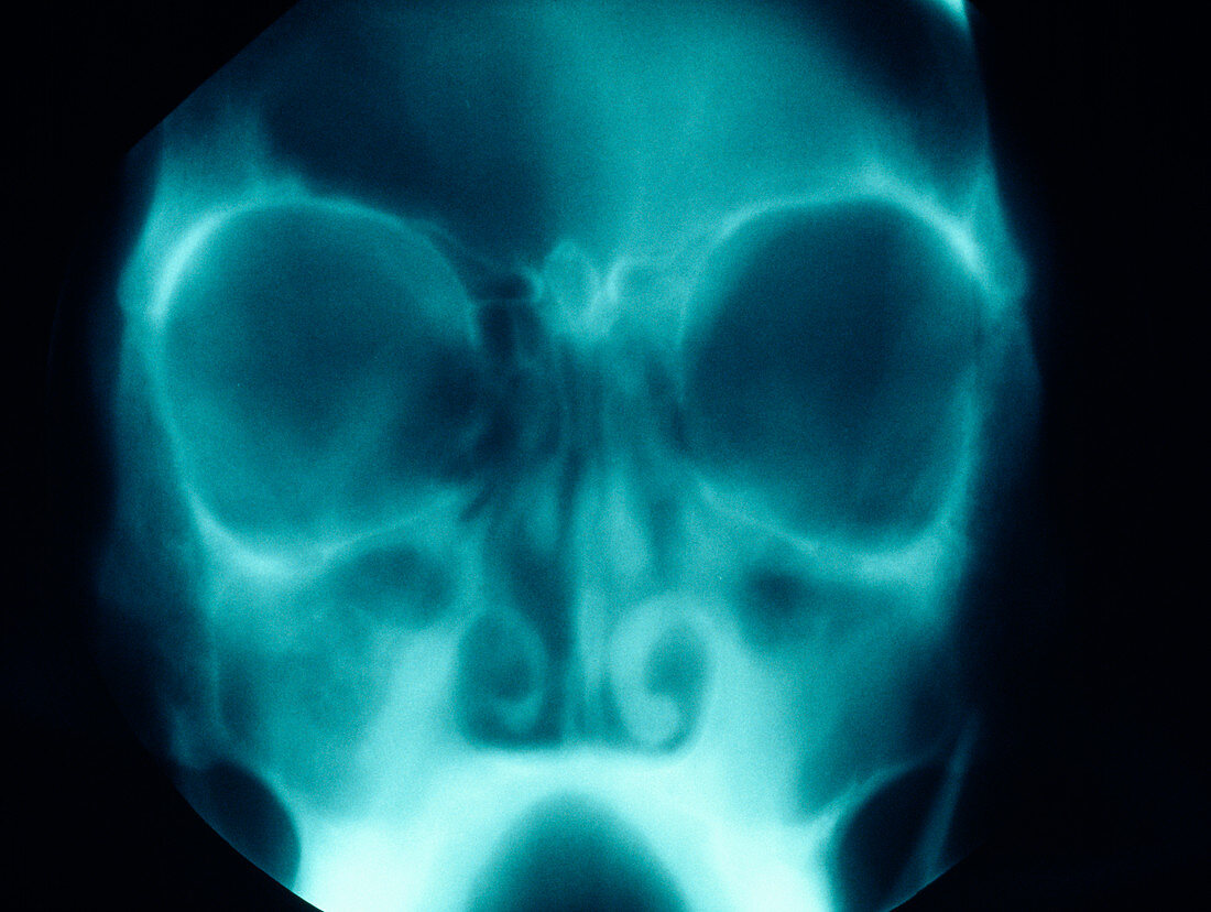 Inflamed sinuses,X-ray