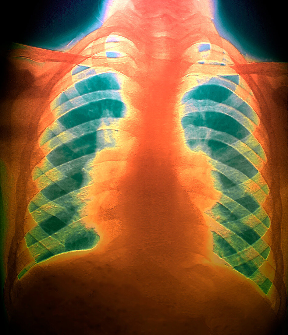 Sarcoidosis of the lungs,X-ray