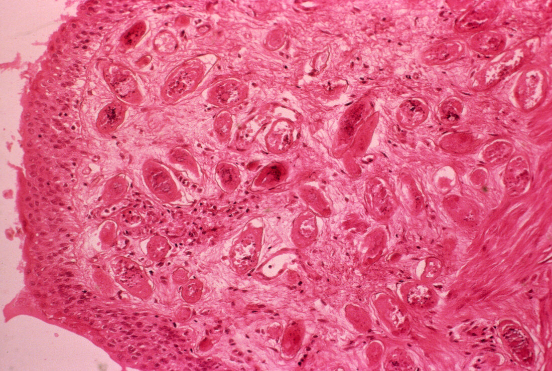 Urinary schistosomiasis,light micrograph