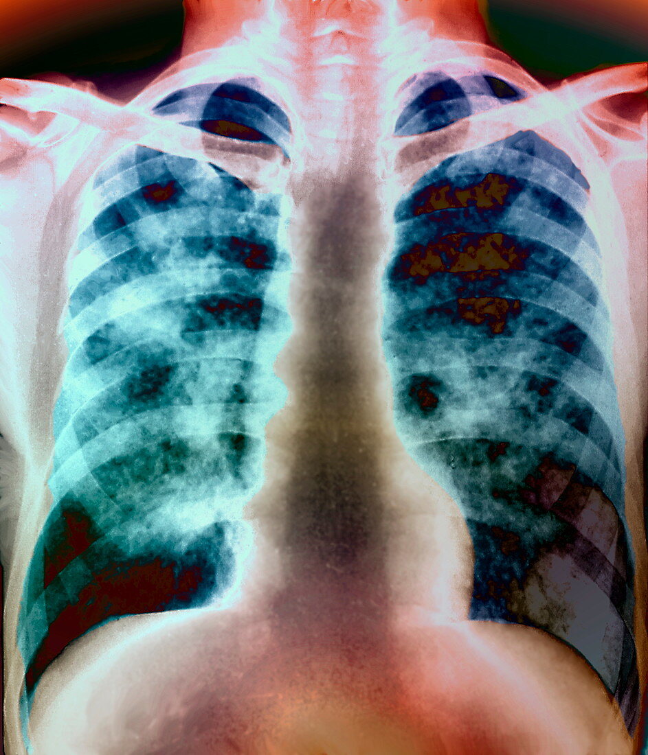 Lung silicosis,X-ray