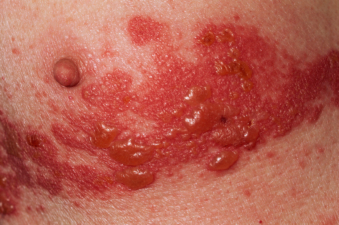 Shingles rash