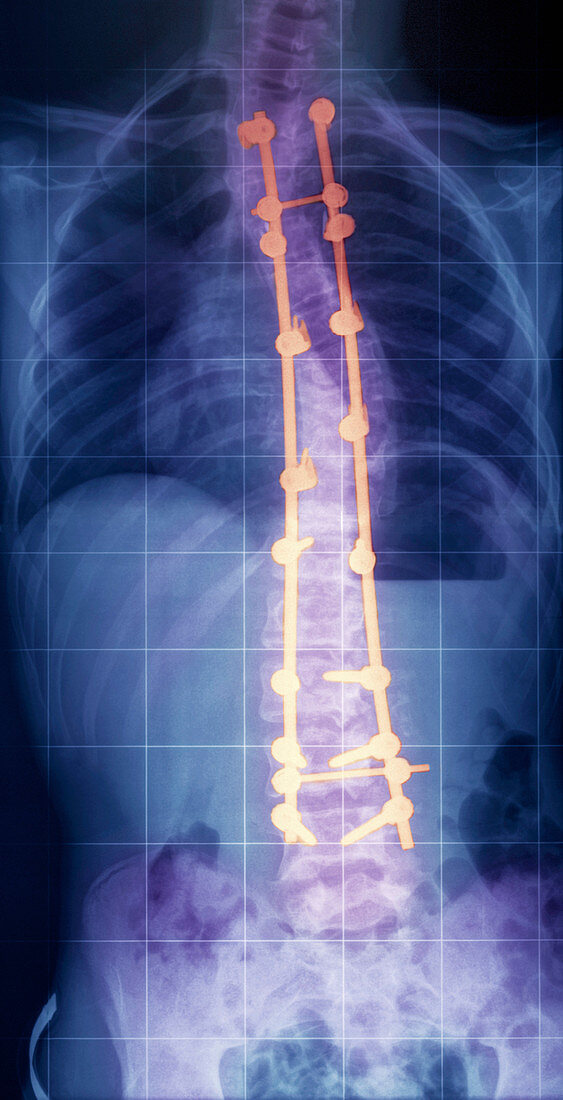 Pinned spine in Sotos syndrome,X-ray
